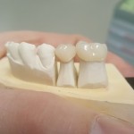 Pre-molar eMax