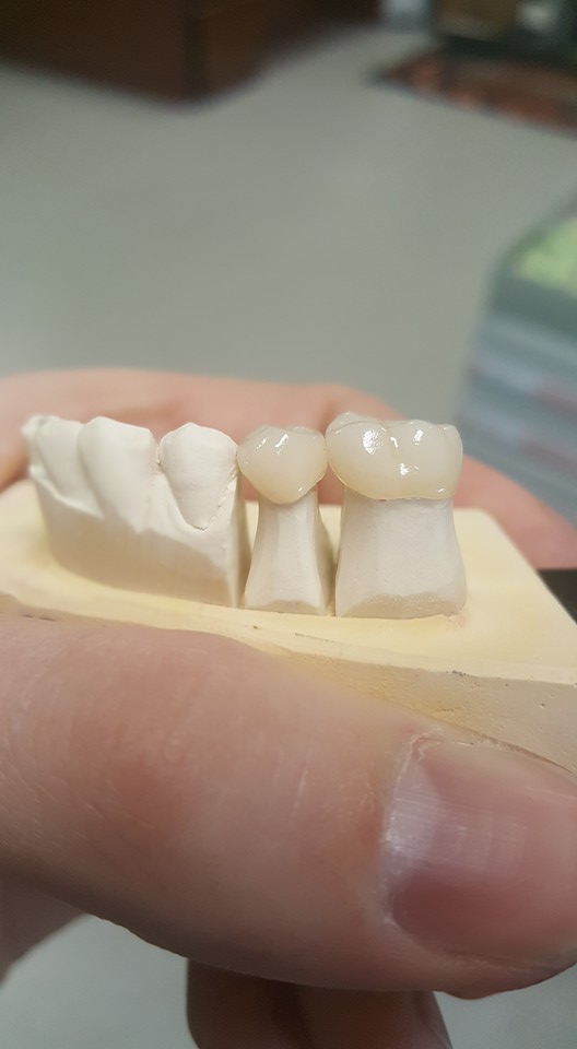 Pre-molar eMax